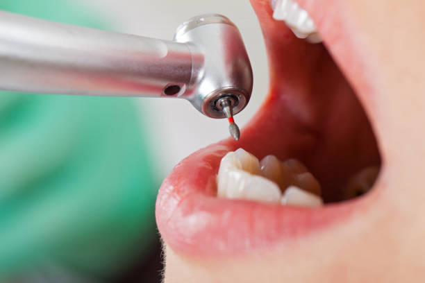 Best Emergency Wisdom Tooth Extraction in Country Squire Lakes, IN